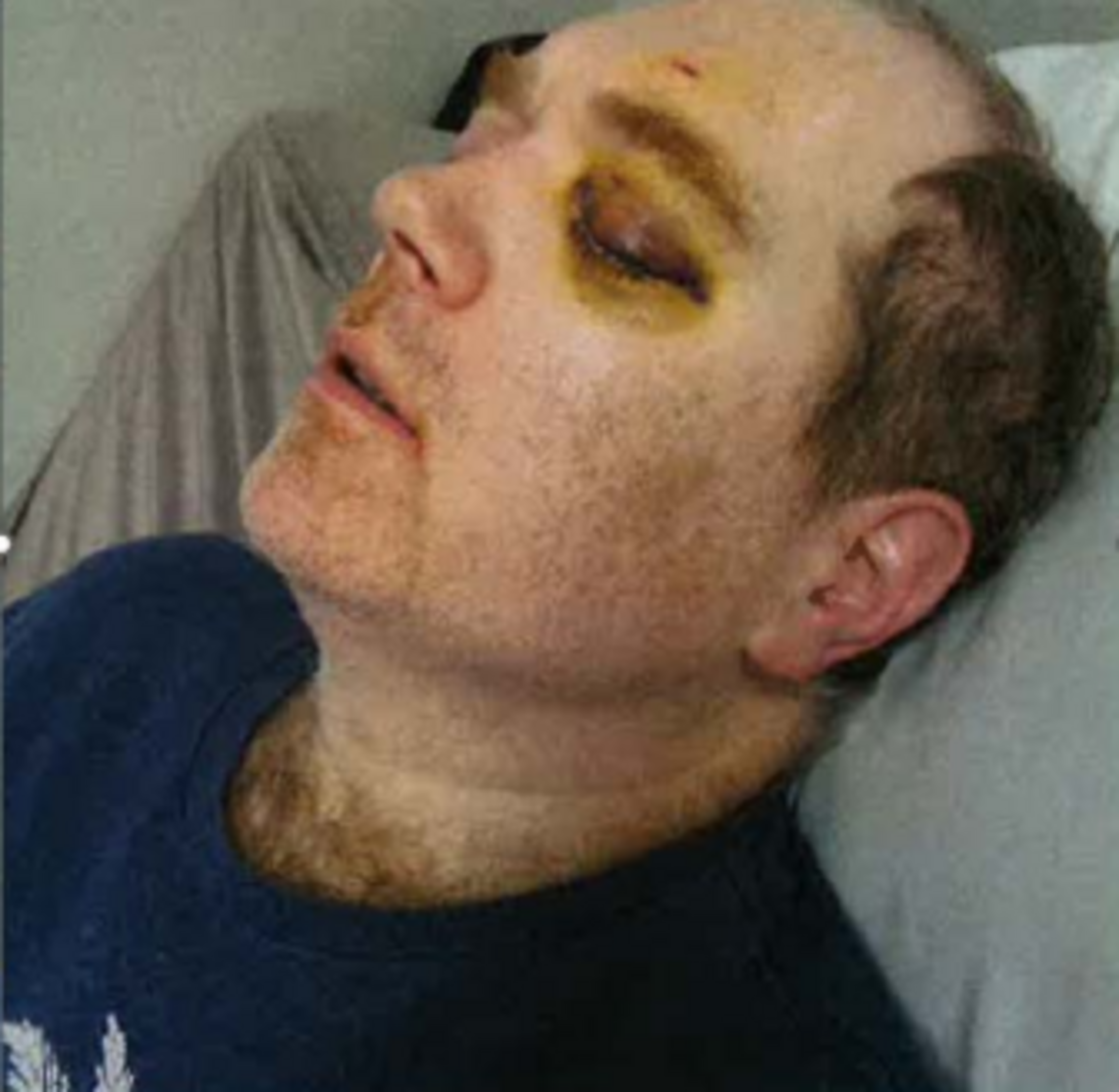 A Rainier School resident was punched in the eye. His assailant was a caregiver