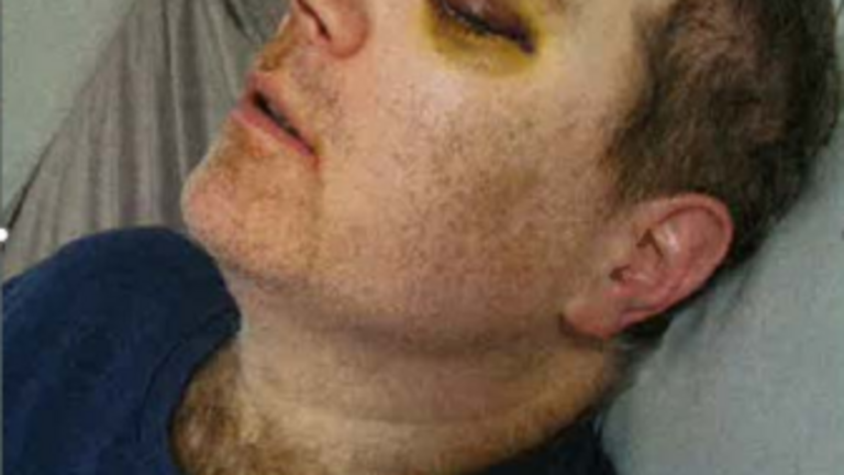 A Rainier School resident was punched in the eye. His assailant was a caregiver