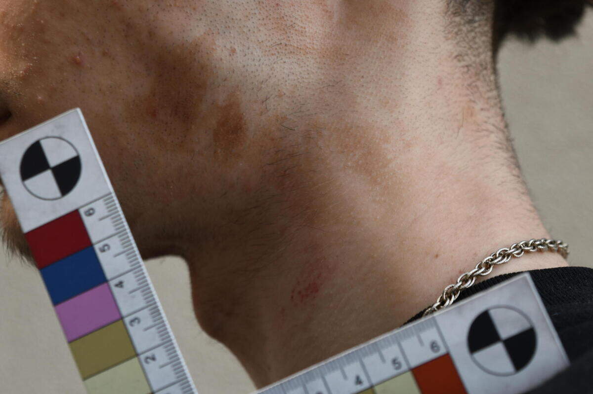 A photograph shown in Pierce County Juvenile Court on Tuesday, May 13, 2025 shows bruising to a 15-year-old’s neck who is accused of fatally stabbing his mother’s boyfriend. The teen’s attorney said in court that the photo shows his client was choked by the victim, 23-year-old Malik Session.