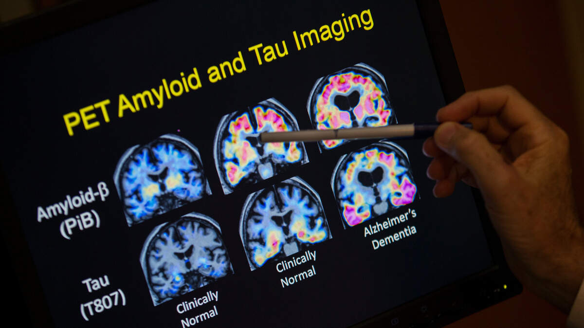 R. Scott Turner, Professor of Neurology and Director of the Memory Disorder Center at Georgetown University Hospital, points to PET scan results that are part of a study on Alzheimer’s disease at Georgetown University Hospital in Washington. An upcoming forum is geared to offer more information on the disease, while Tacoma researchers are seeking more volunteers for two Alzheimer’s studies.