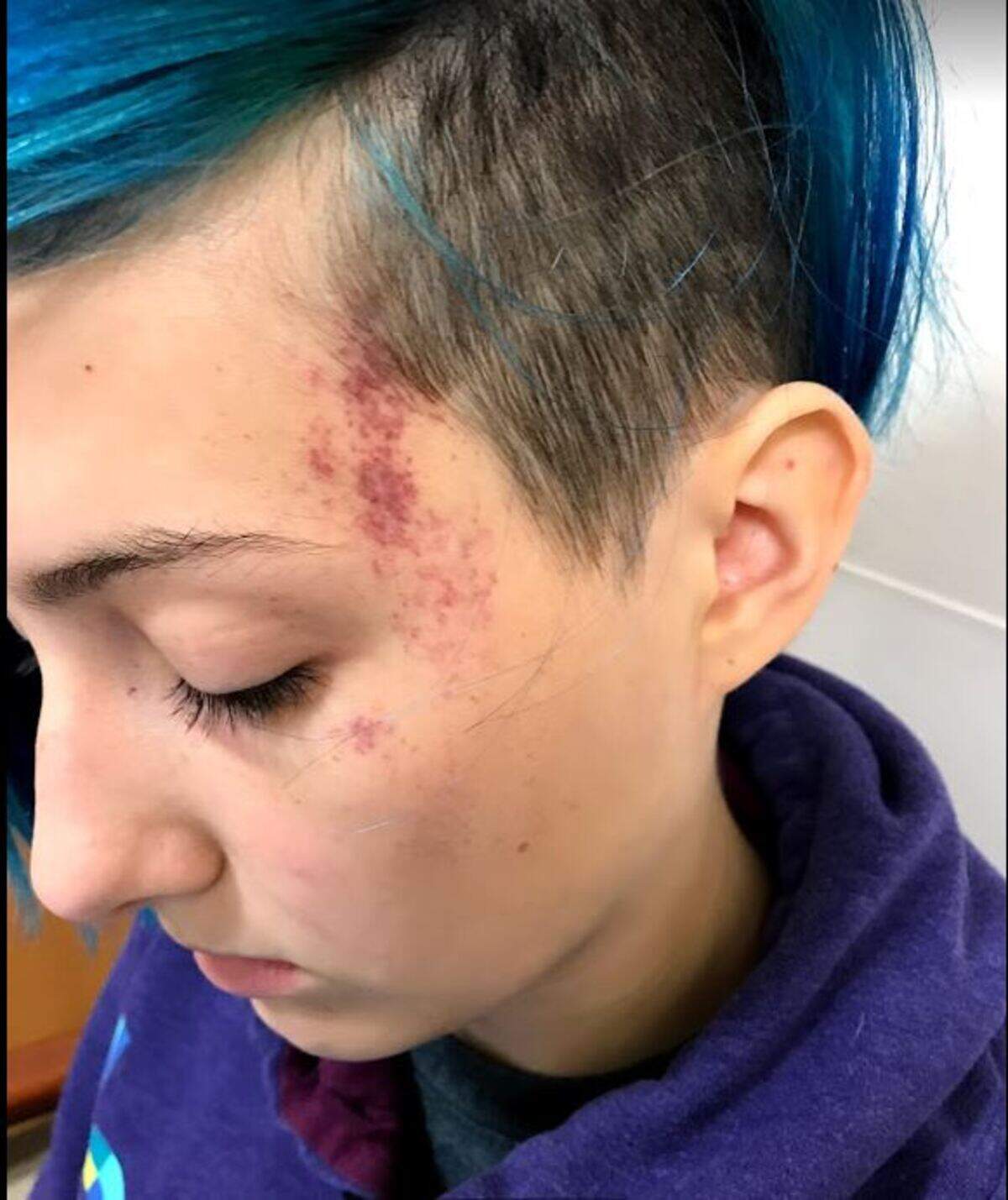 After large bruises appeared on Hailee Hutton's face and knees, her mother became worried and took her to a doctor. The teen was diagnosed with Severe Aplastic Anemia.
