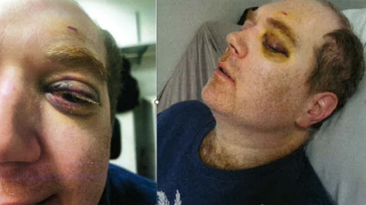 Shawn Hassig was punched by a caregiver at Rainier School on Aug. 1, 2025, resulting in eye injuries.