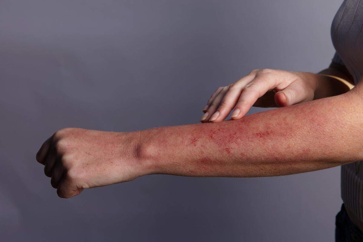 Heat rash can occur from spending too much time in hot weather and sunlight, resulting in sweating that starts the irritation.