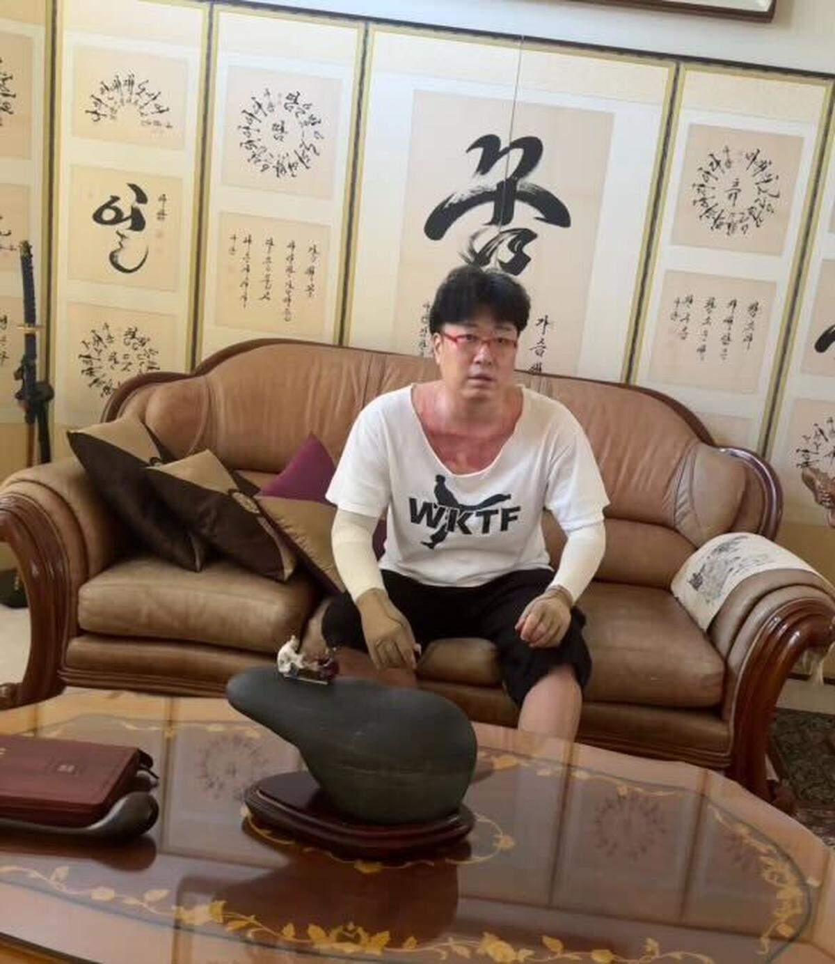 Federal Way resident Jiho Yoon in his home months after getting discharged from a hospital for severe burns when a driver drove a car into a restaurant he worked at in Puyallup, Wash.