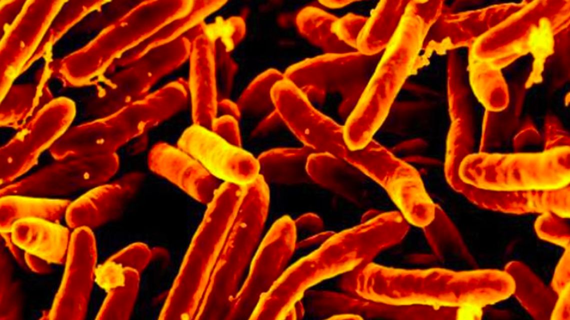 En Kansas se está produciendo un brote de tuberculosis “sin precedentes”. ¿Están en riesgo los californianos?