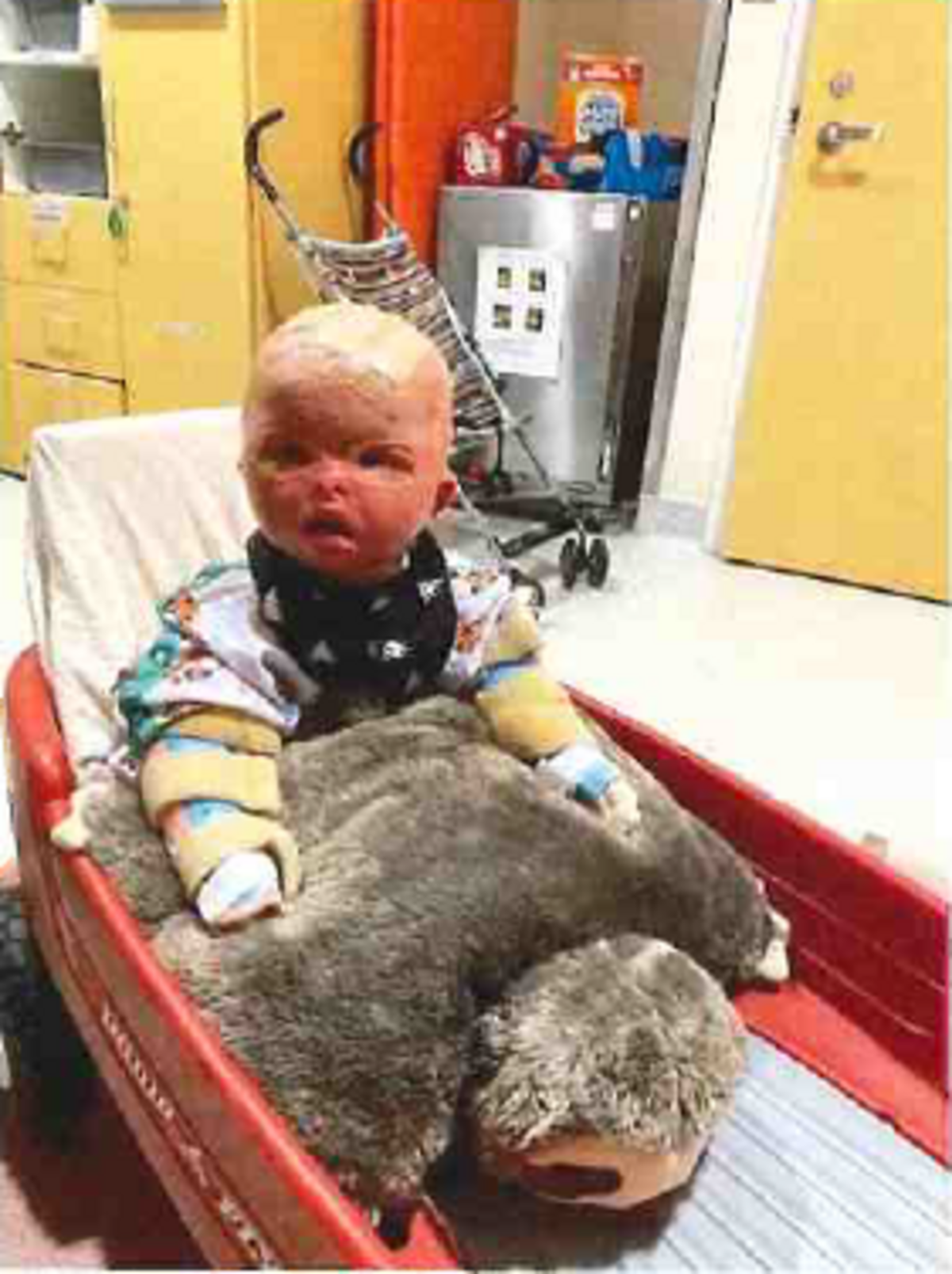 Leo “Bubby” Strode was badly burned in a 2020 shed fire at 9 months old.