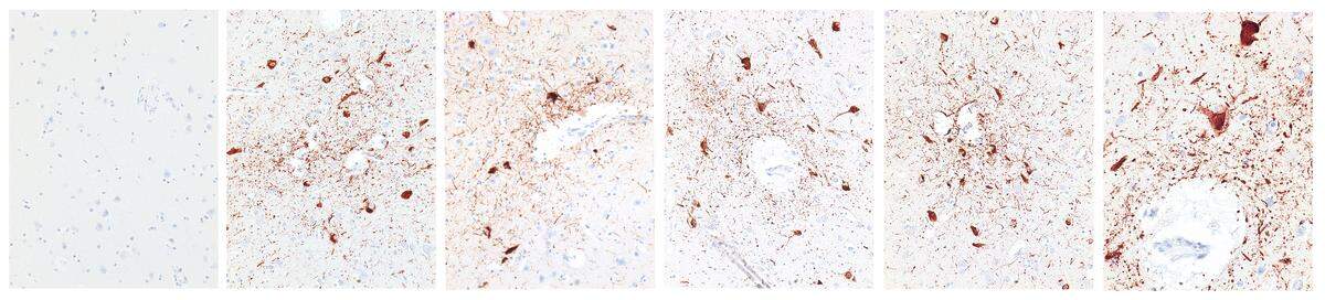 A combo photo provided by the VA Boston Healthcare System/Boston University Schoo of a normal brain, far left, and Daniel Te’o-Nesheim’s brain, shown in microscopic photographs, which had chronic traumatic encephalopathy lesions in multiple areas. Te’o-Nesheim, who played four seasons in the NFL and was found dead at age 30, left a paper trail of his struggles dealing with CTE’s now familiar symptoms — including paranoia, disorientation, memory lapses and angry outbursts.
