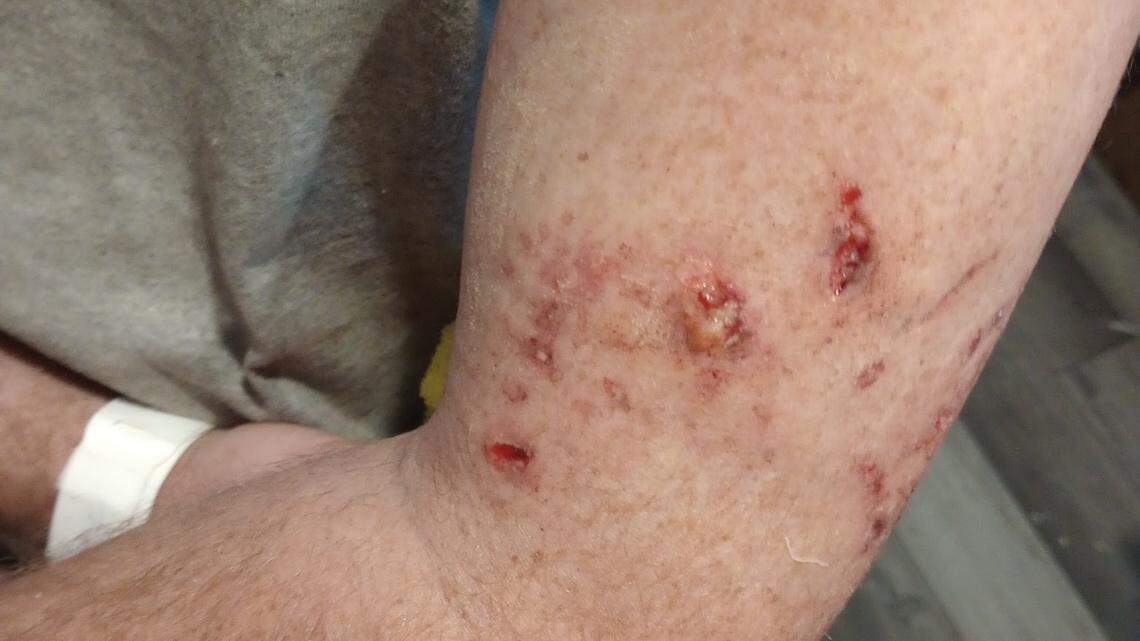 A Sheriff’s Office K-9 bit him. Pierce County paid $20K to settle