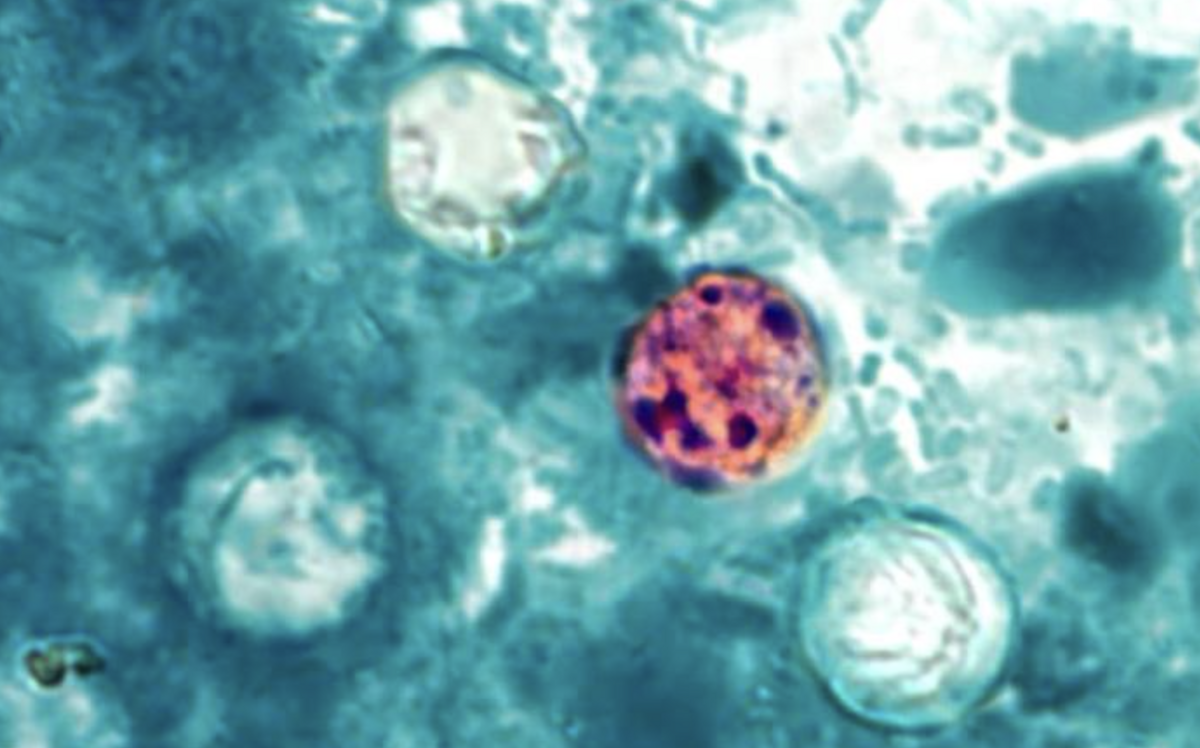 A stool sample revealed the presence of Cyclospora parastic structures. The U.S. is seeing historically high case levels of cyclosporiasis.