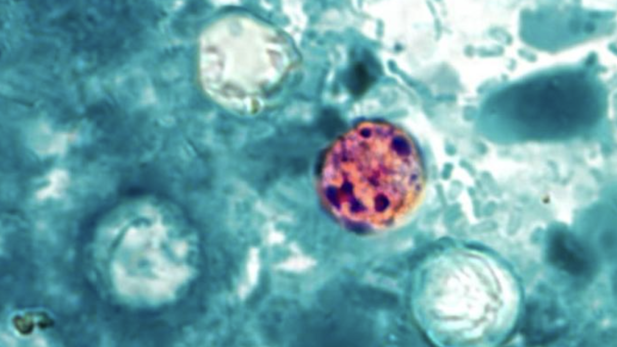 A stool sample revealed the presence of Cyclospora parastic structures. The U.S. is seeing historically high case levels of cyclosporiasis.