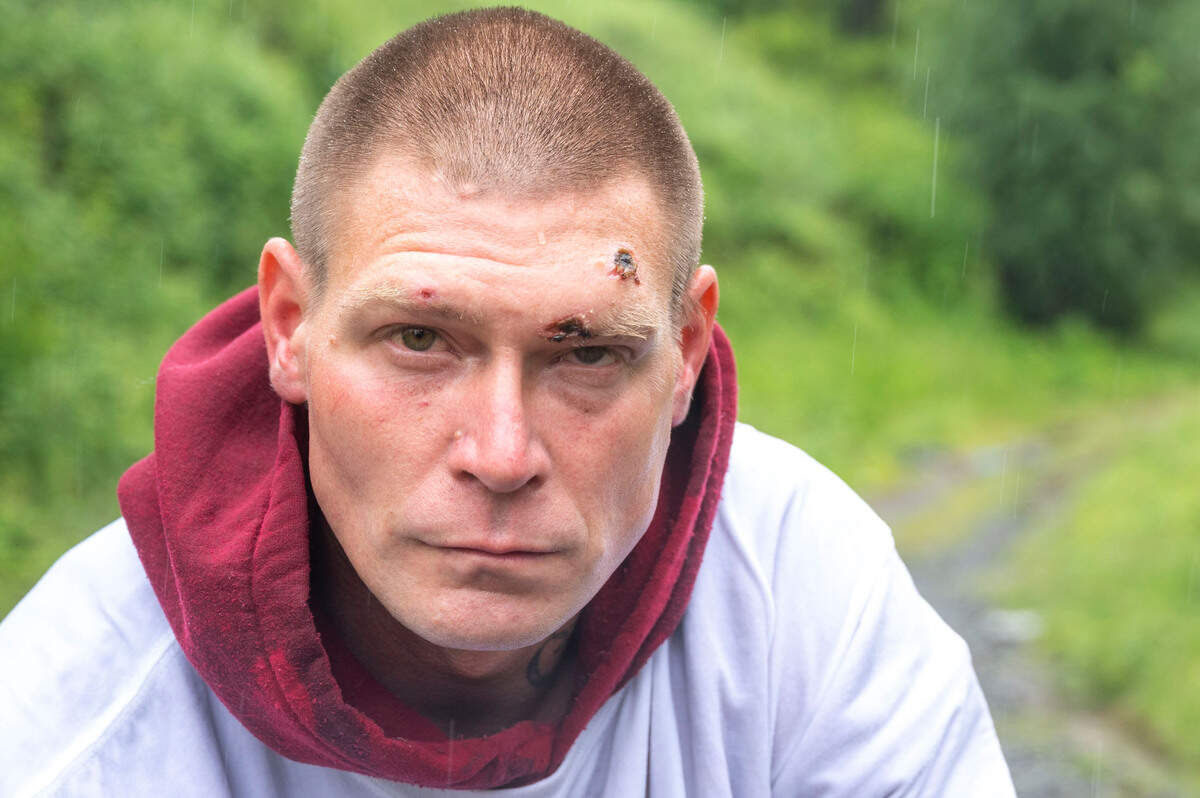 Scars from a bullet wound show over the left eye of Scott Stacy as he poses for a portrait near where he was living in Tacoma, Wash., on Thursday, June 9, 2022. Stacy claims he wasn’t shot by Josh Harris, a Pierce County Council candidate, but was shot by a Tacoma Police officer during an incident on May 30 at a homeless encampment north of Cheney Stadium on May 30, 2022.
