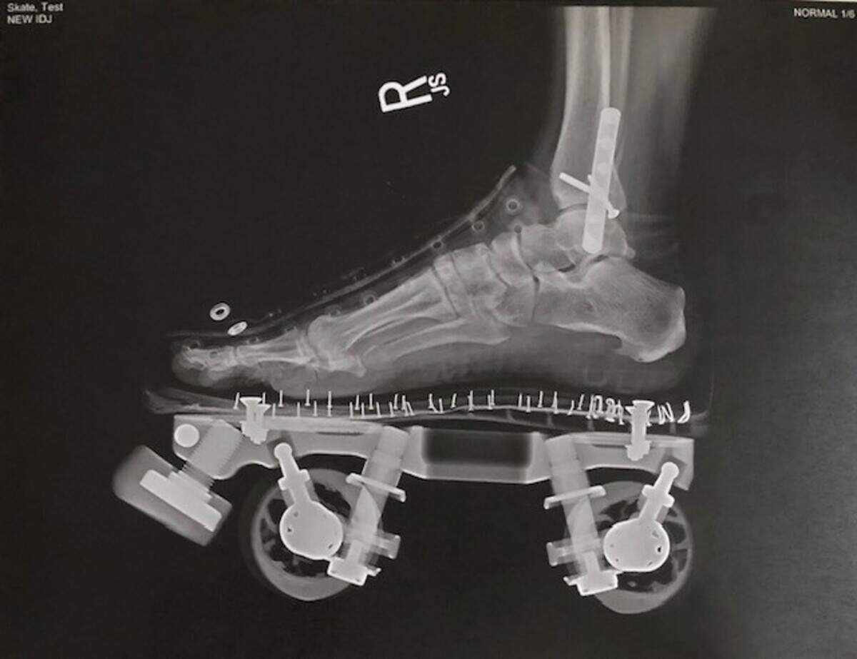 An X-ray of Aashiyana “Bones” Koreishi’s broken ankle. She talked the technician into including her skate.