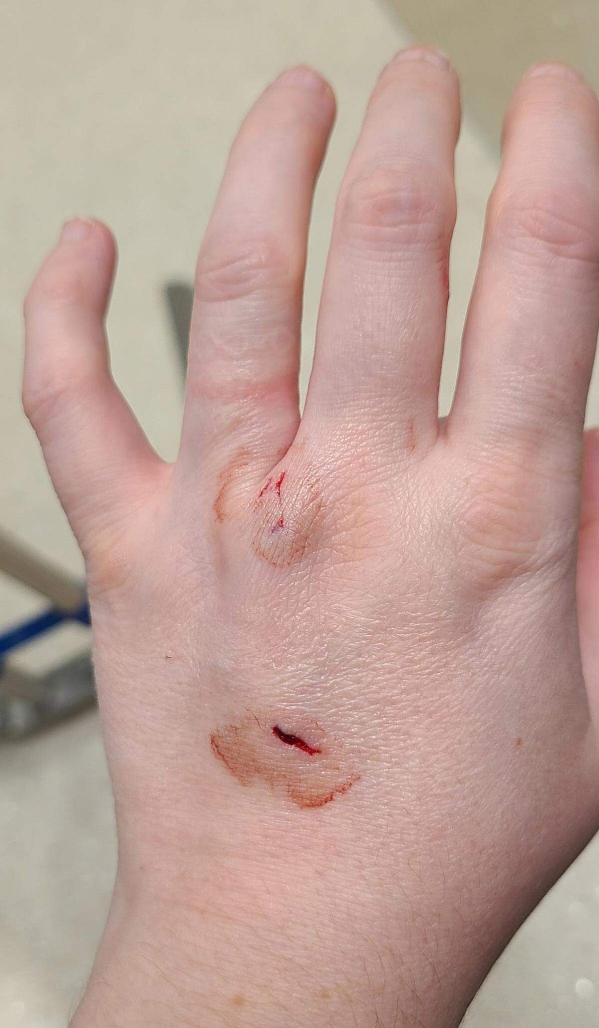 A pregnant woman from Federal Way was bitten by a squirrel in the Browns Point area of Tacoma on March 18, 2026. Alysha K. sent this photo of her injuries to The News Tribune on March 25, 2026.