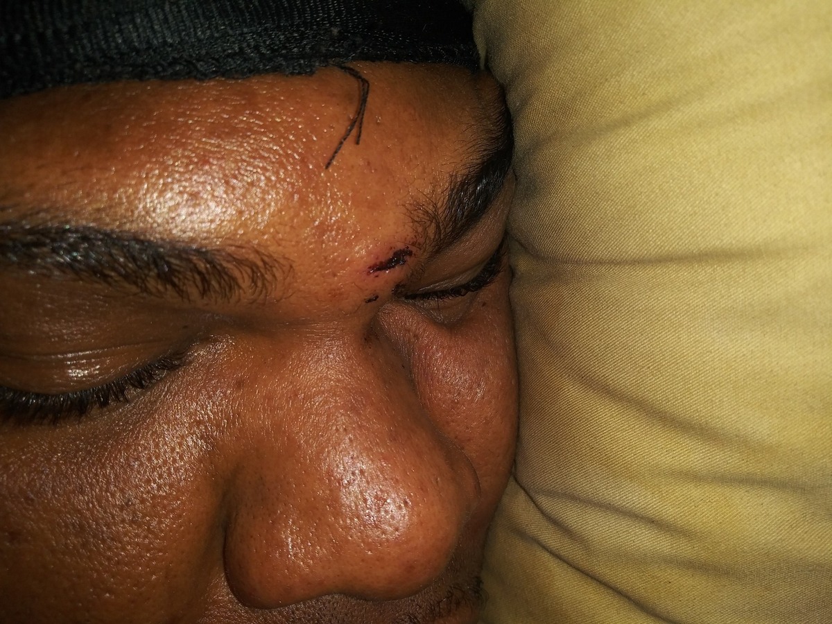A photo of Kevin Williamson taken after he was beaten and arrested the night of Feb. 27, 2021 in Lakewood, Washington, shows a wound on his forehead. Williamson is suing the City of Lakewood, its police department and the four officers involved in his arrest.