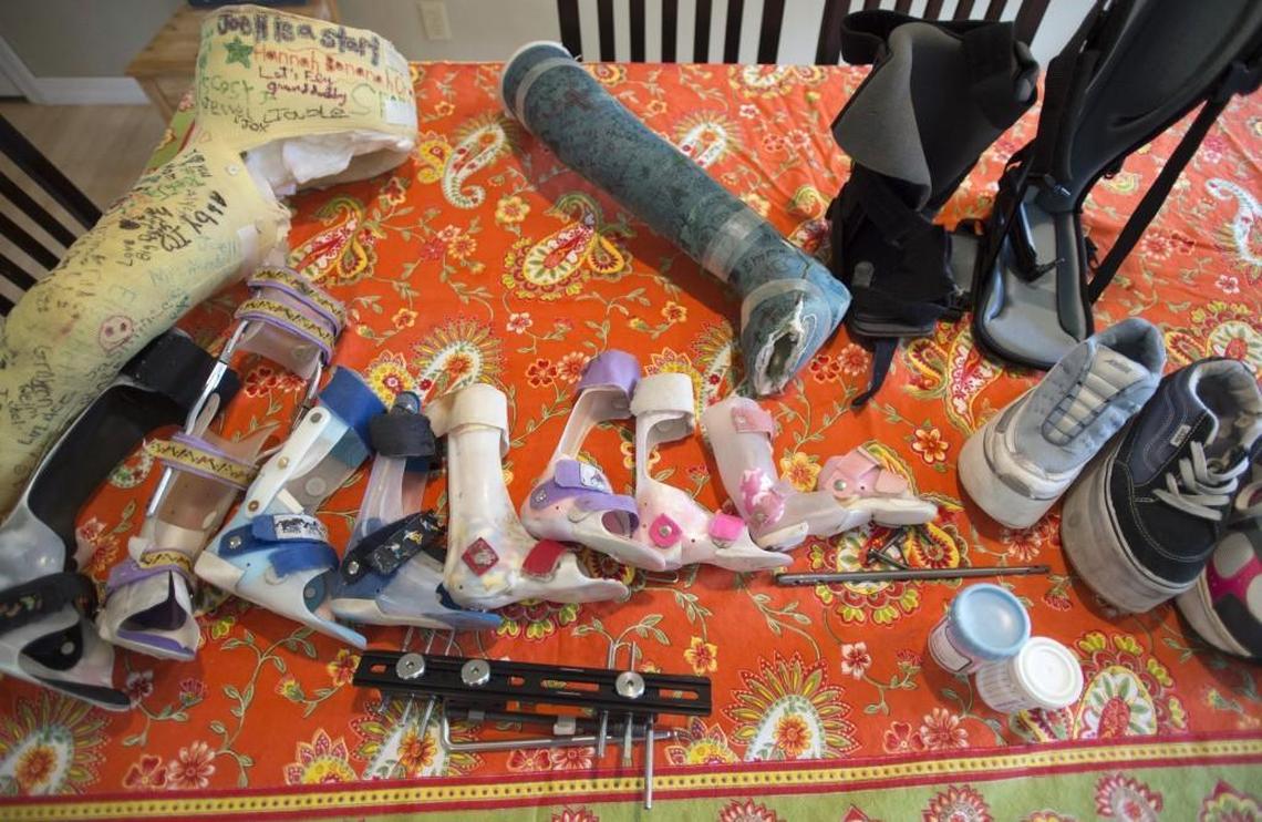Leg braces from childhood to adult chronicle the 20-year process to lengthen Joeli Reim’s leg, shown at her family’s home in Fircrest on June 27.